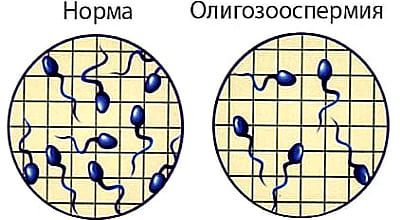 Астенотератозооспермия у мужчин: что это такое как ее лечить, можно ли забеременеть естественным путем с этим диагнозом?
