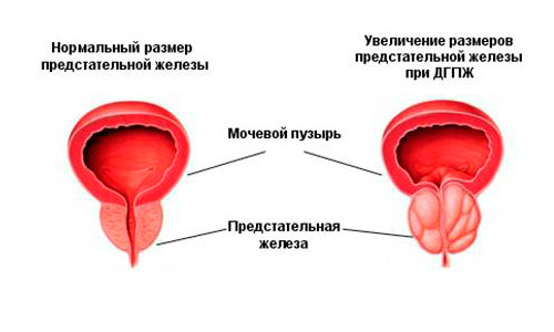 Простаторея: симптомы, лечение и меры профилактики