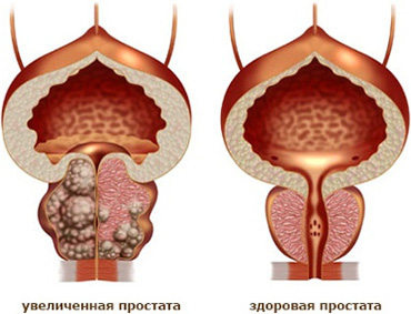 ПРЕДСТАТЕЛЬНАЯ ЖЕЛЕЗА