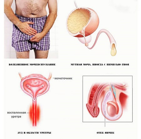 Симптомы и лечение урологических заболеваний у мужчин