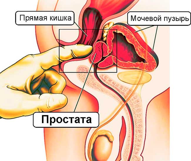 Свечи для снятия боли при простатите