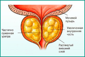 Недержание мочи у мужчин причины и лечение