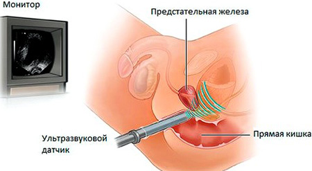 Как лечить застойный конгестивный простатит