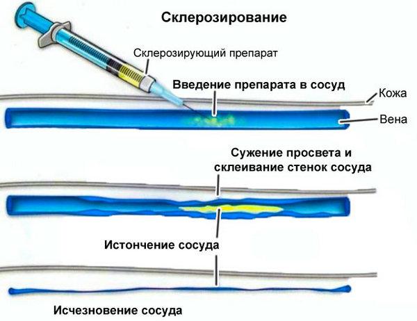Хирургическое лечение патологического венозного дренажа кавернозных тел