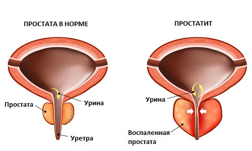 Боли в пояснице и яичках при простатите