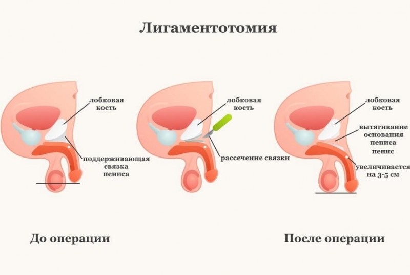 Удлинение полового члена (лигаментотомия)
