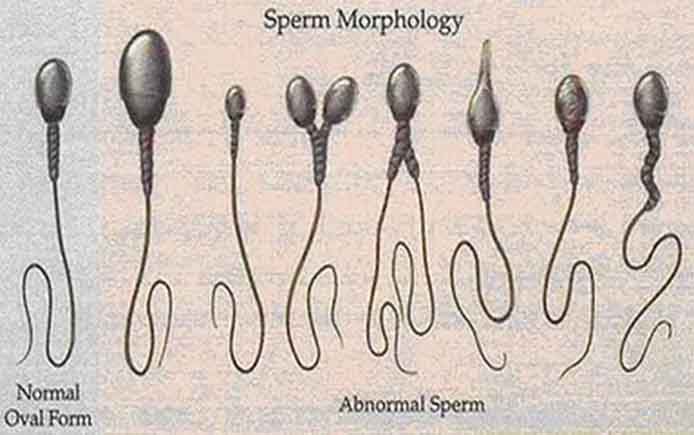 Патологические формы в спермограмме и нормы: аномалии головки, шейки, хвоста