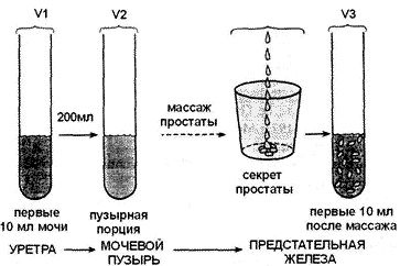 Хронический простатит очаговый фиброз