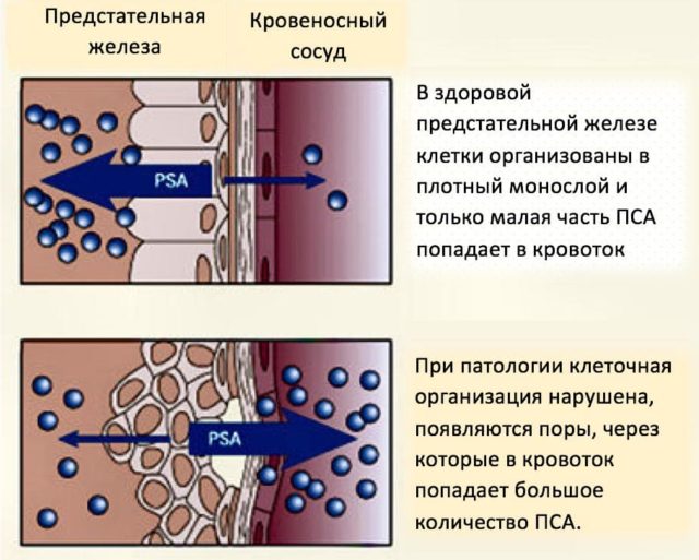 Биохимический рецидив рака предстательной железы